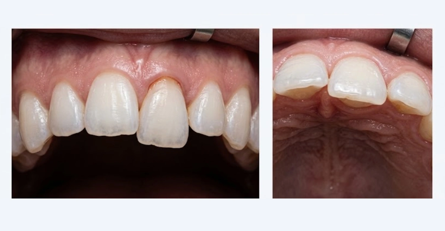 Tooth Luxation inblog